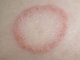 Ringworm: Picture, causes, symptoms and treatment